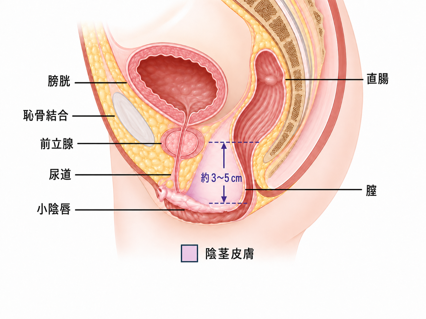 制限深度膣形成術後の模式図。膀胱、恥骨結合、前立腺、尿道、小陰唇、膣入口、および約 3～5 cm の浅層膣空間の位置関係を示す。