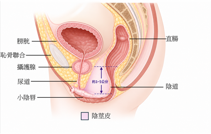限制深度陰道成型術後示意圖，標示膀胱、恥骨聯合、攝護腺、尿道、小陰唇、陰道與約 3 至 5 公分的淺層陰道空間位置。