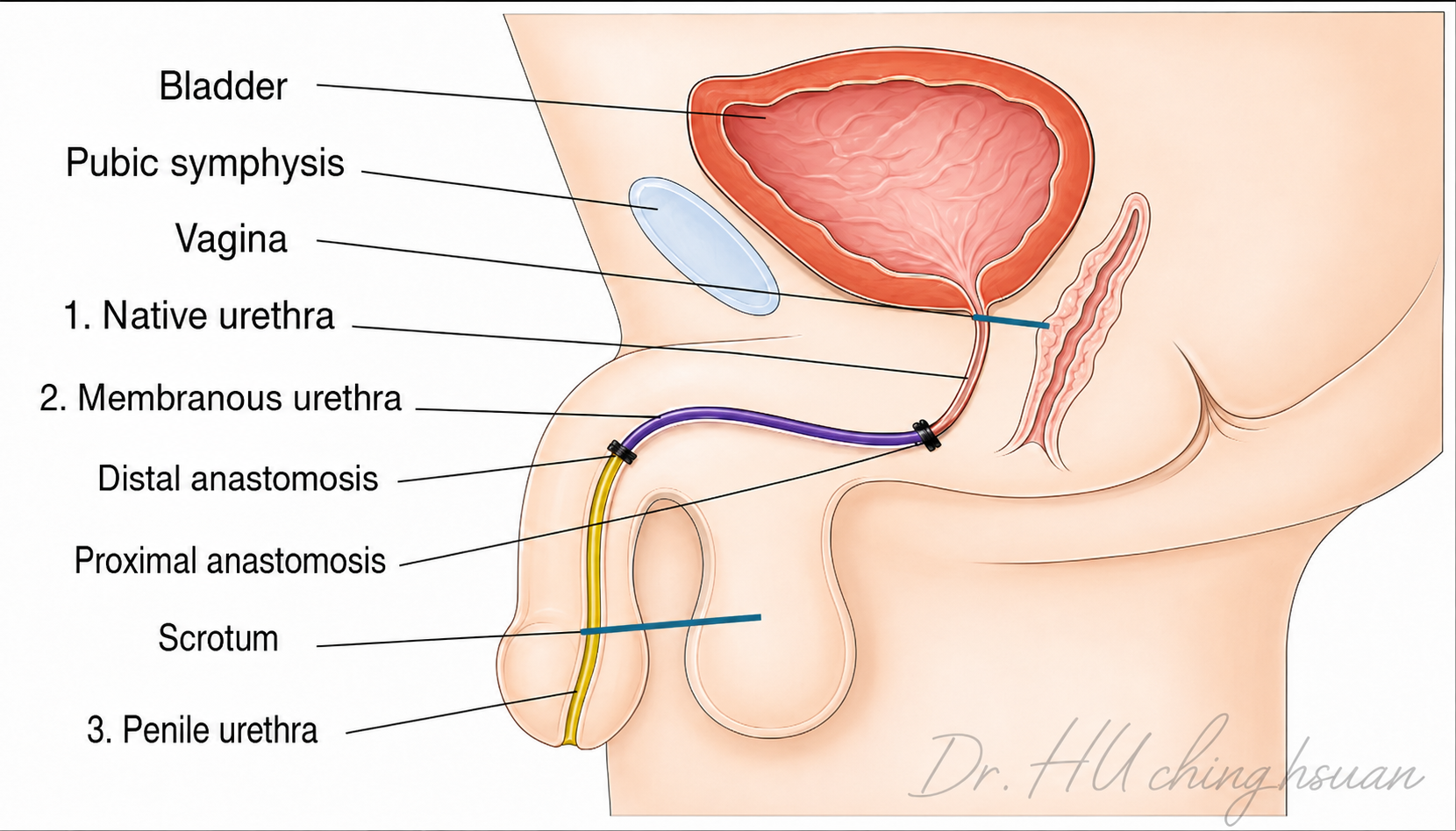 Diagram of mid-segment urethral lengthening