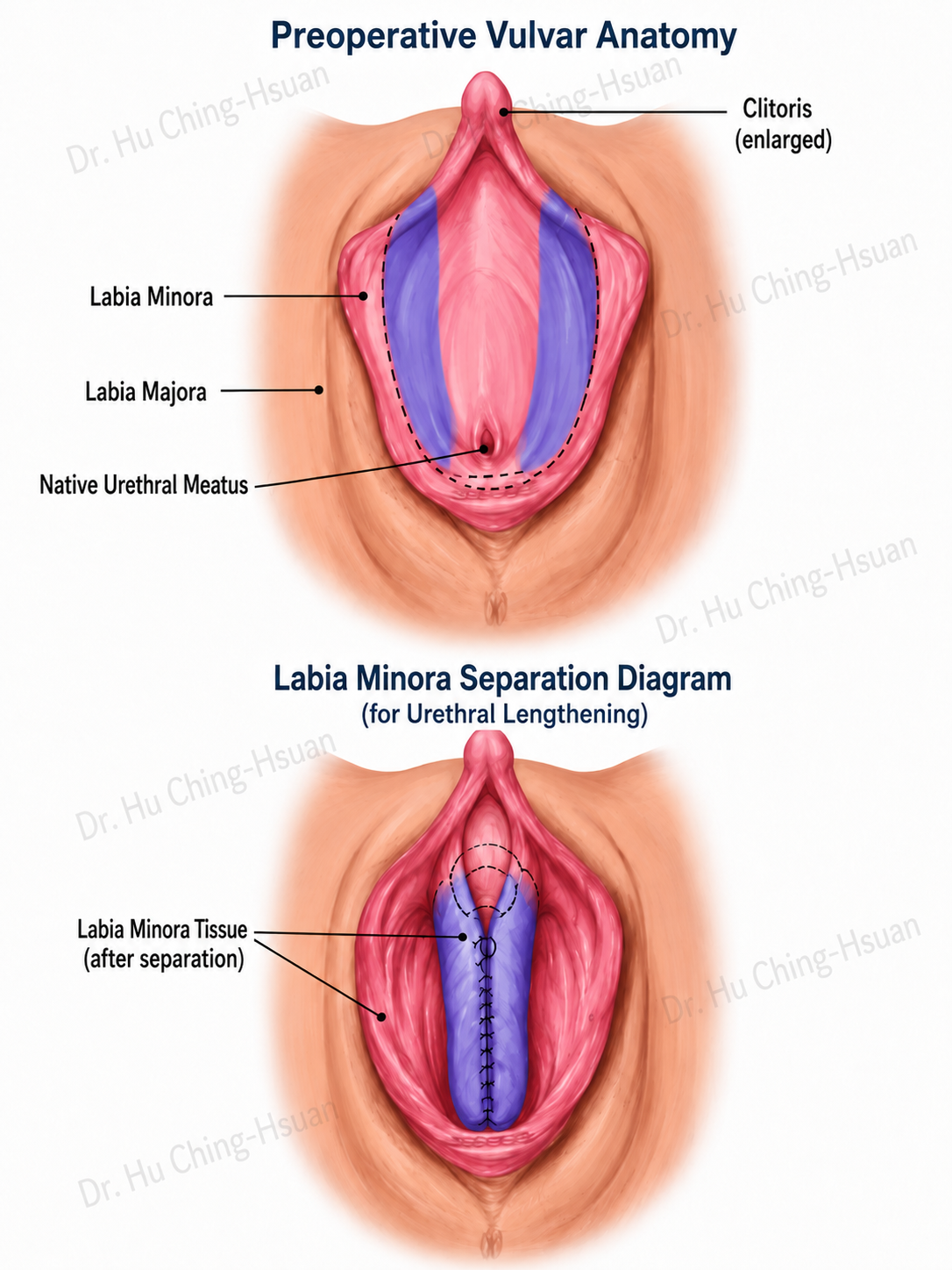 Perineal anatomy diagram for transgender men