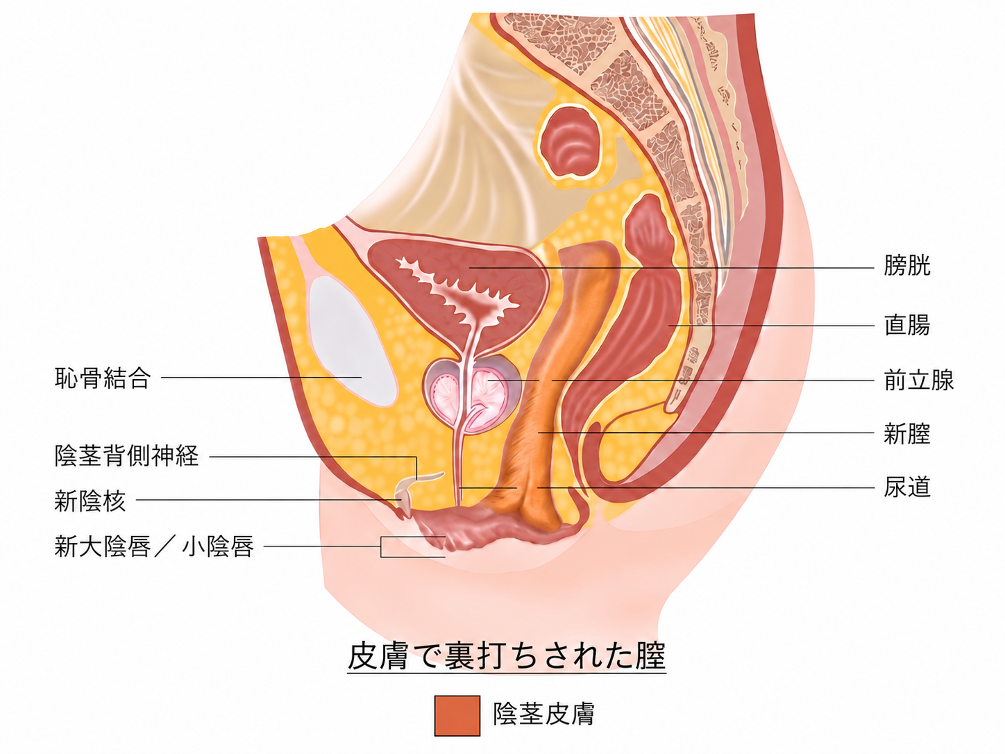 皮膚反転膣形成術後の新膣模式図。新膣、陰核、大陰唇、小陰唇、尿道、前立腺、直腸、膀胱の位置関係を示す。