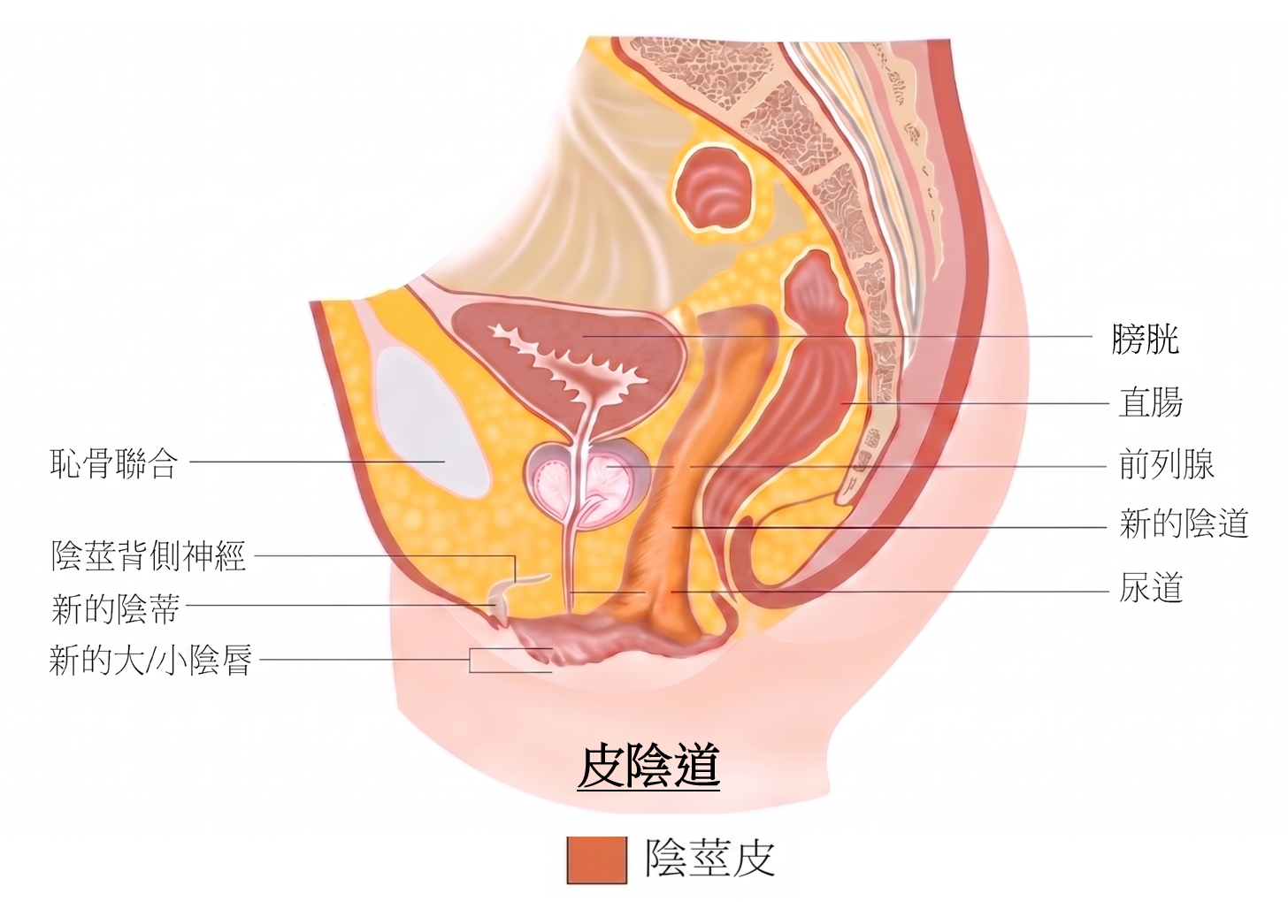 皮膚反轉陰道成型術後新陰道示意圖，標示新陰道、陰蒂、大小陰唇、尿道、前列腺、直腸與膀胱的位置關係。