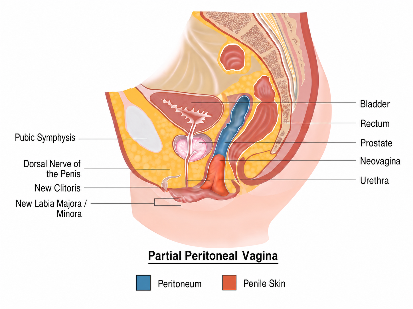 Postoperative neovagina diagram 2
