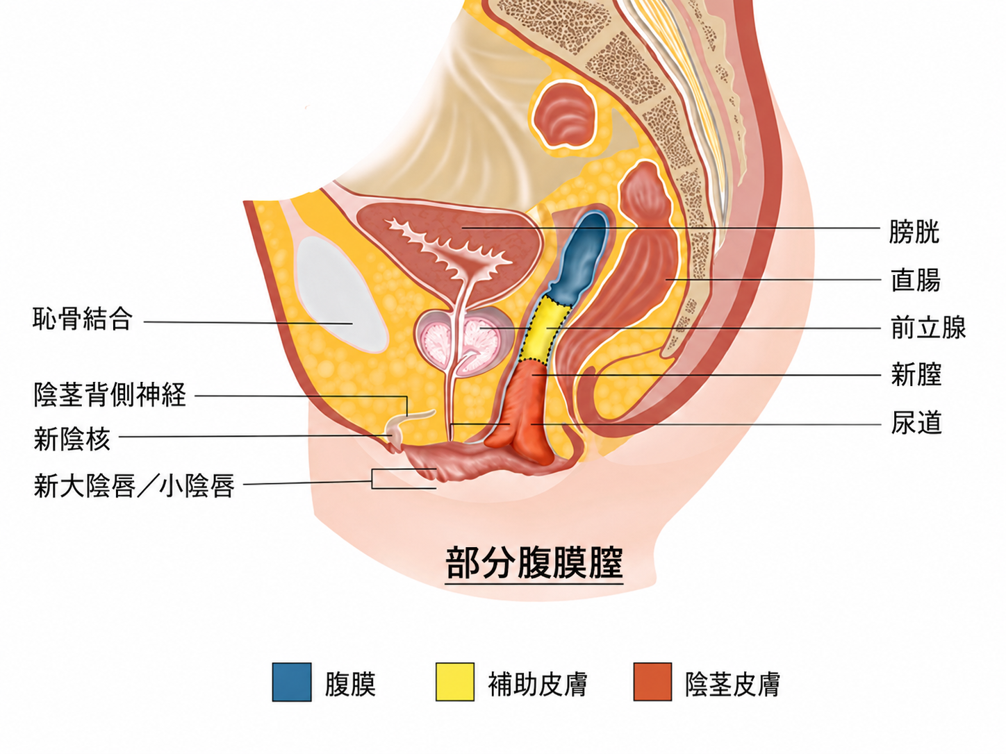 手術後新膣模式図 1