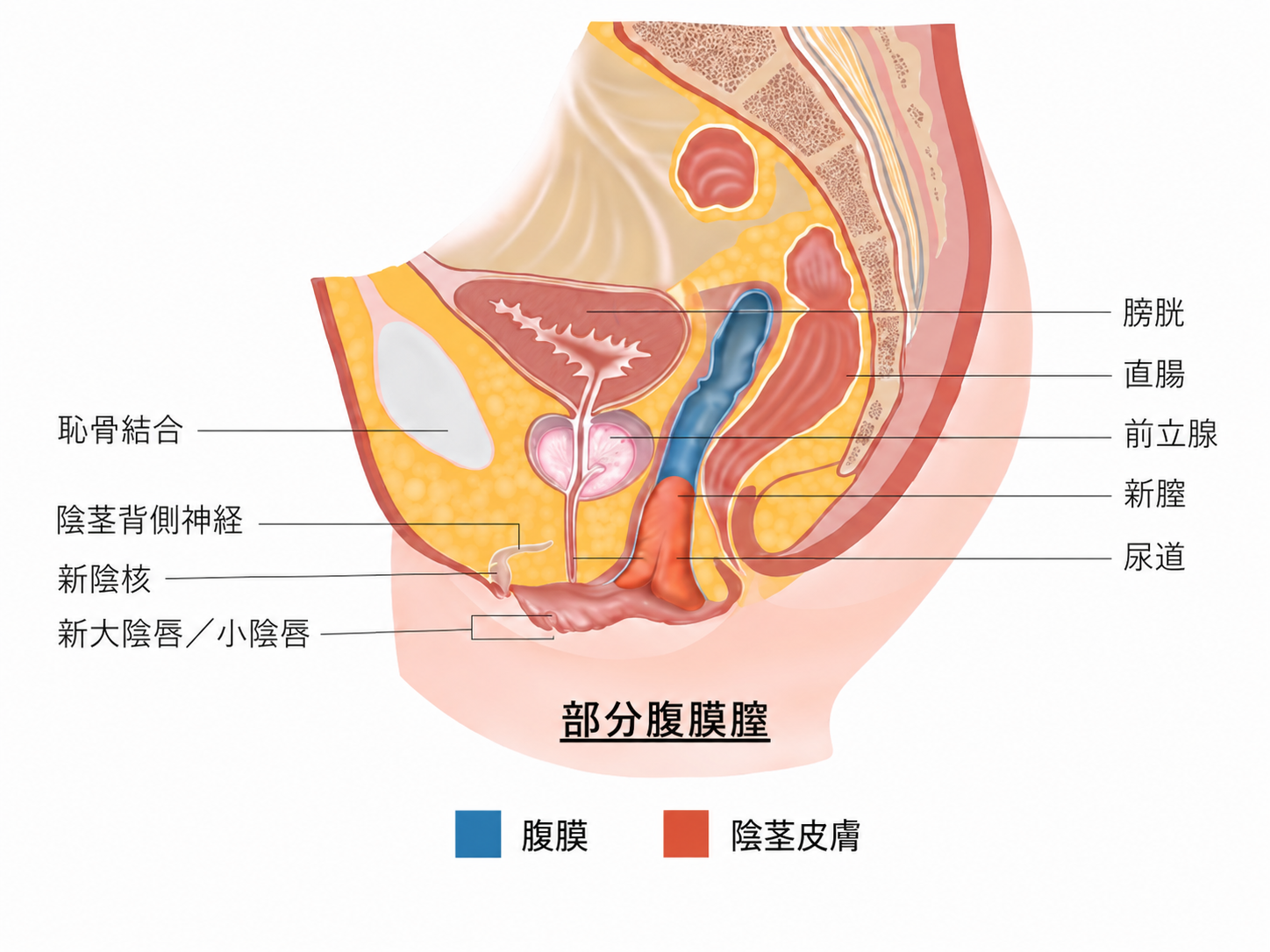 手術後新膣模式図 2