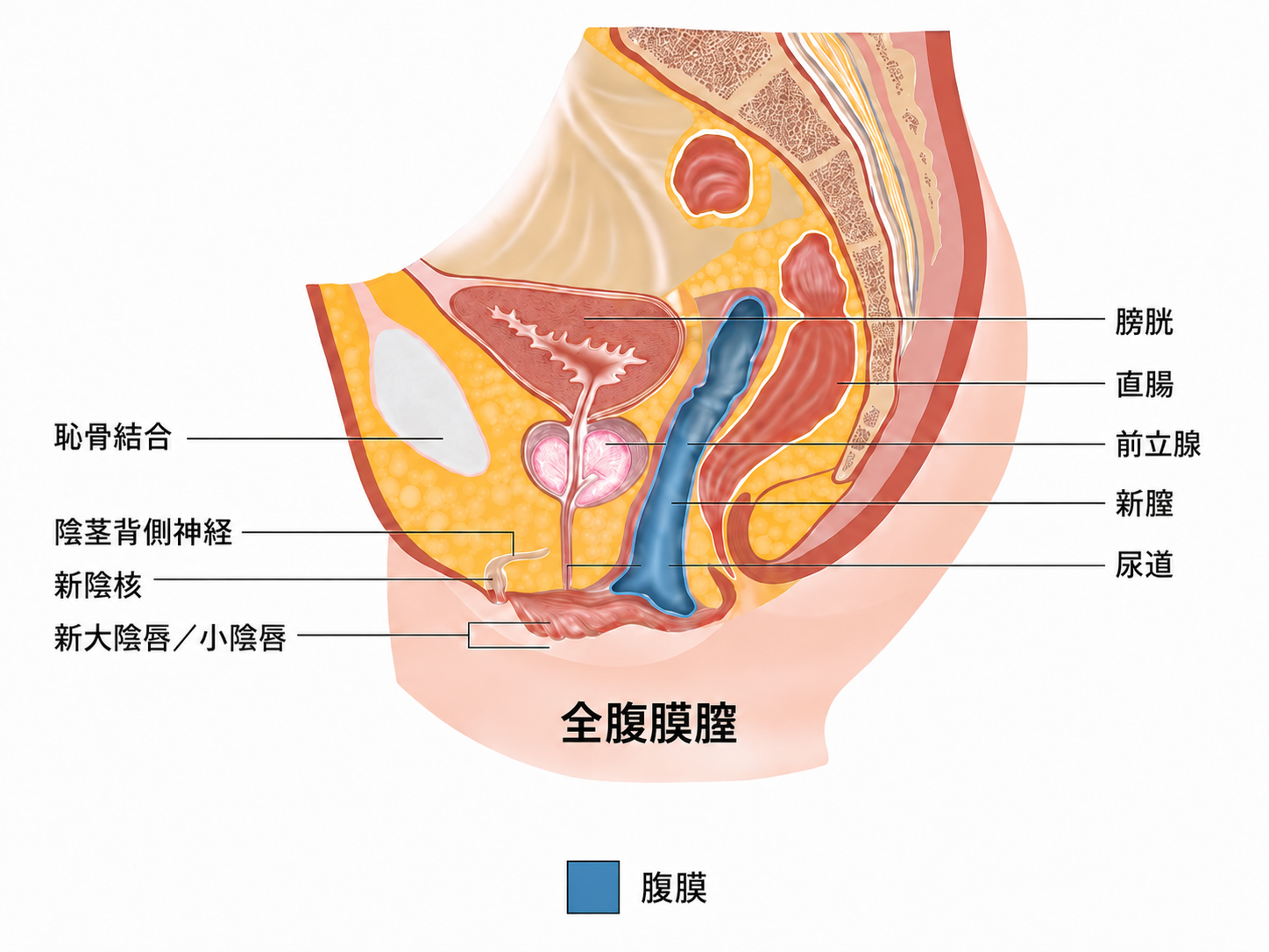手術後新膣模式図 3
