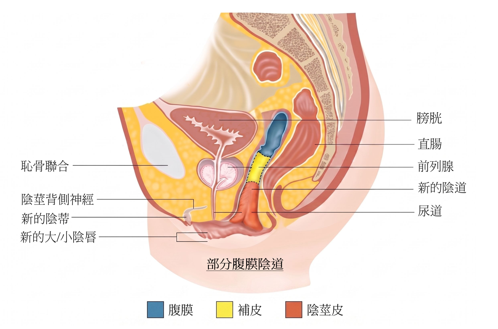 腹膜陰道成型術後示意圖 1