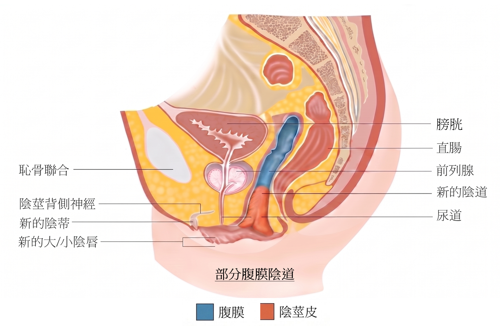 腹膜陰道成型術後示意圖 2