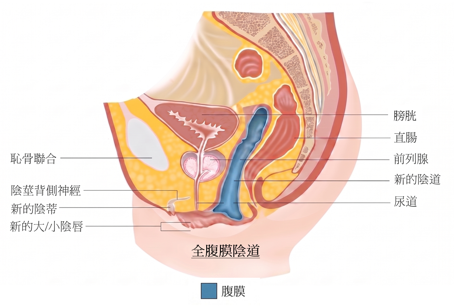 腹膜陰道成型術後示意圖 3