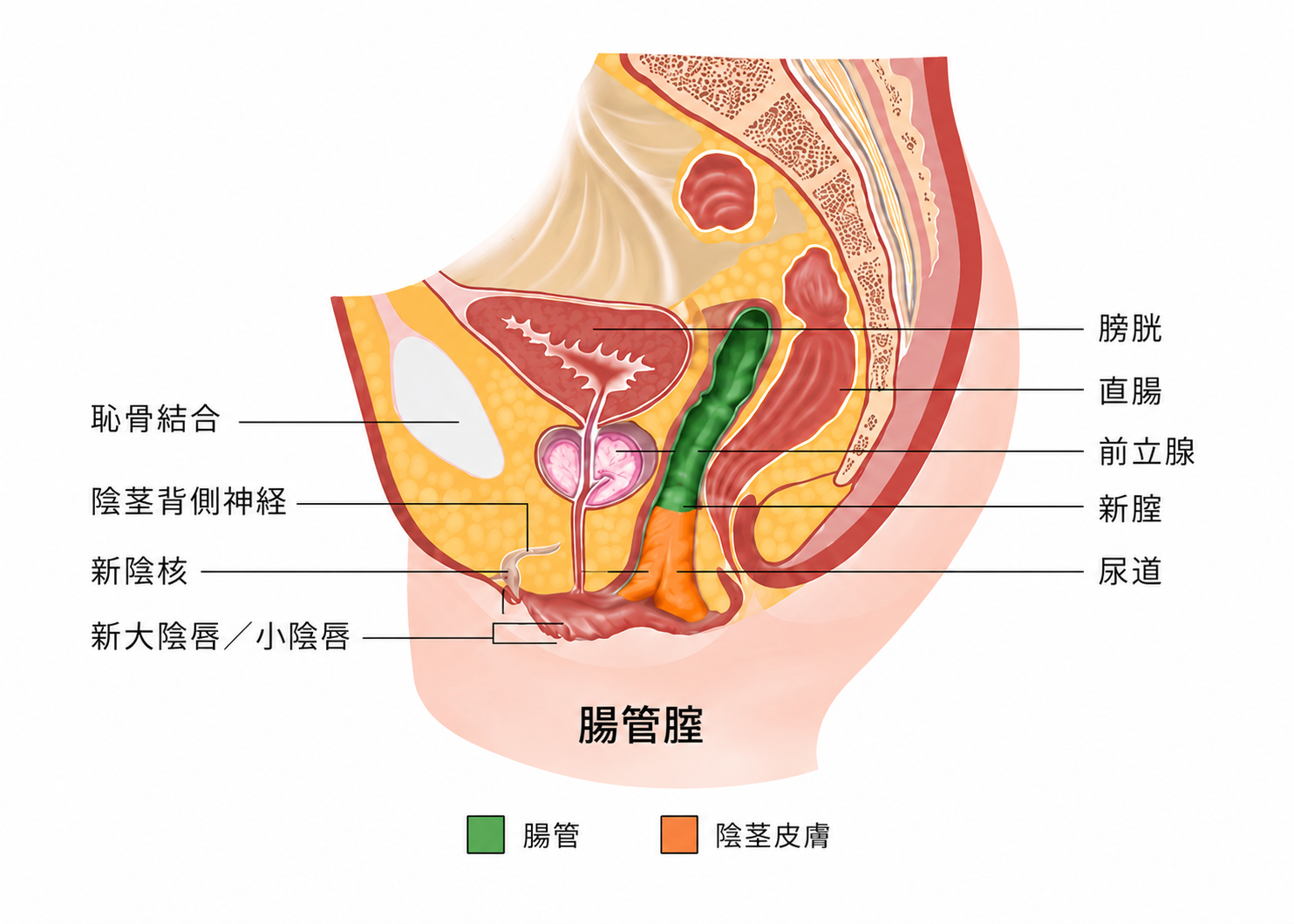 S状結腸膣形成術後の新膣模式図。膣の上部3分の2は腸管組織で、下部3分の1は陰茎皮膚で構成されることを示す。