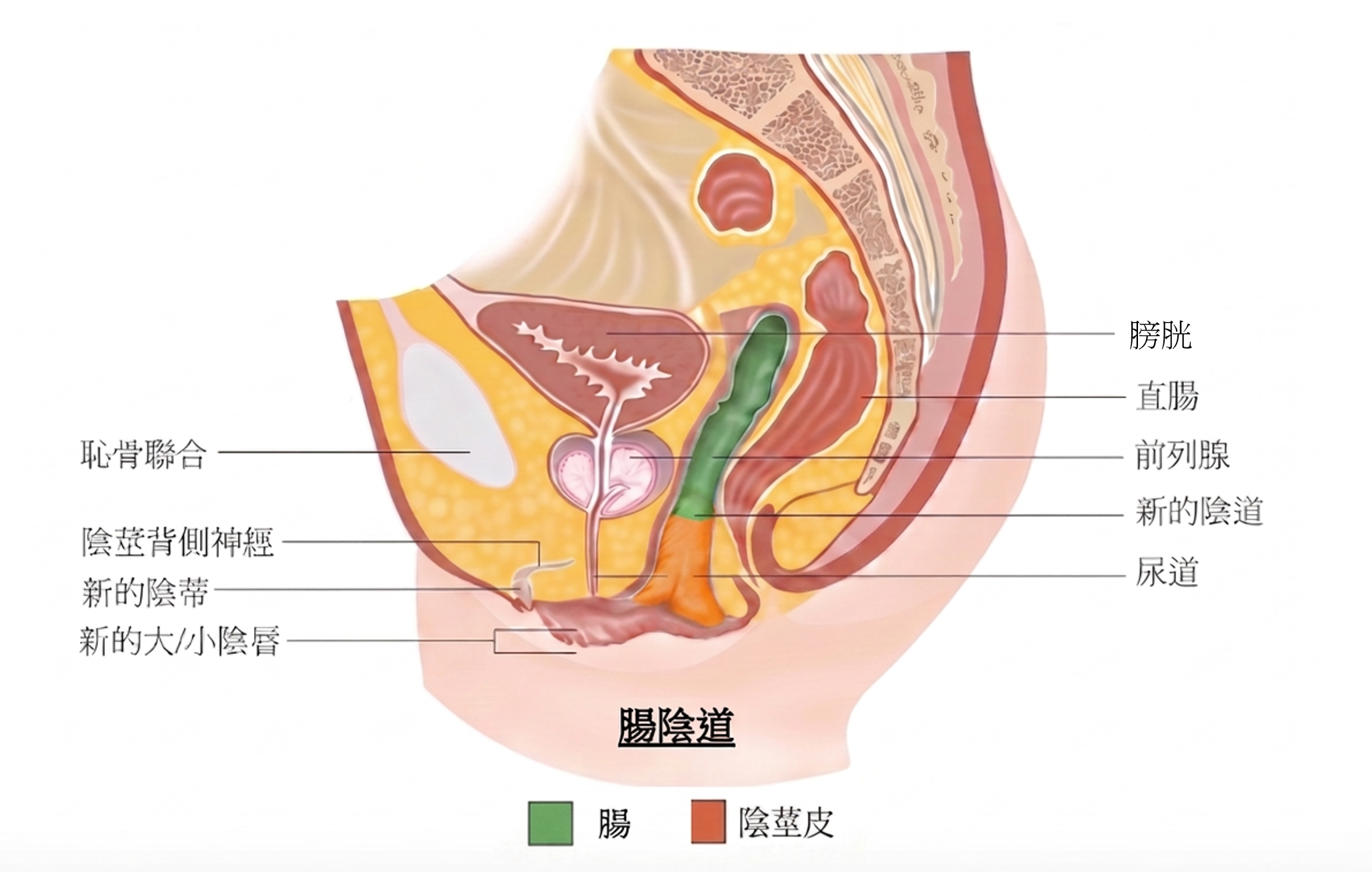 腸道陰道成型術後新陰道示意圖，上三分之二由腸道構成，下三分之一由陰莖皮構成。