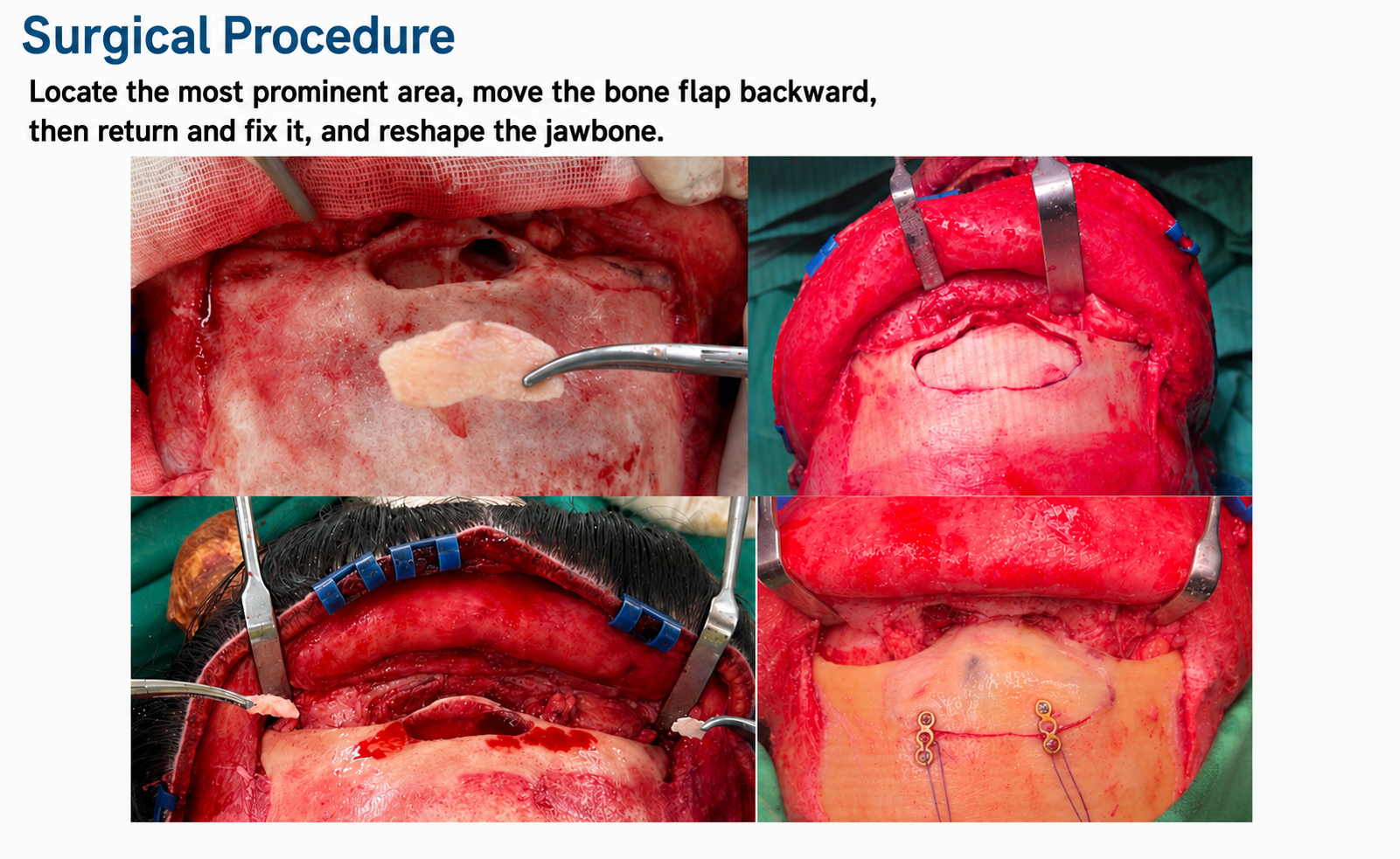 Intraoperative forehead contouring photo.