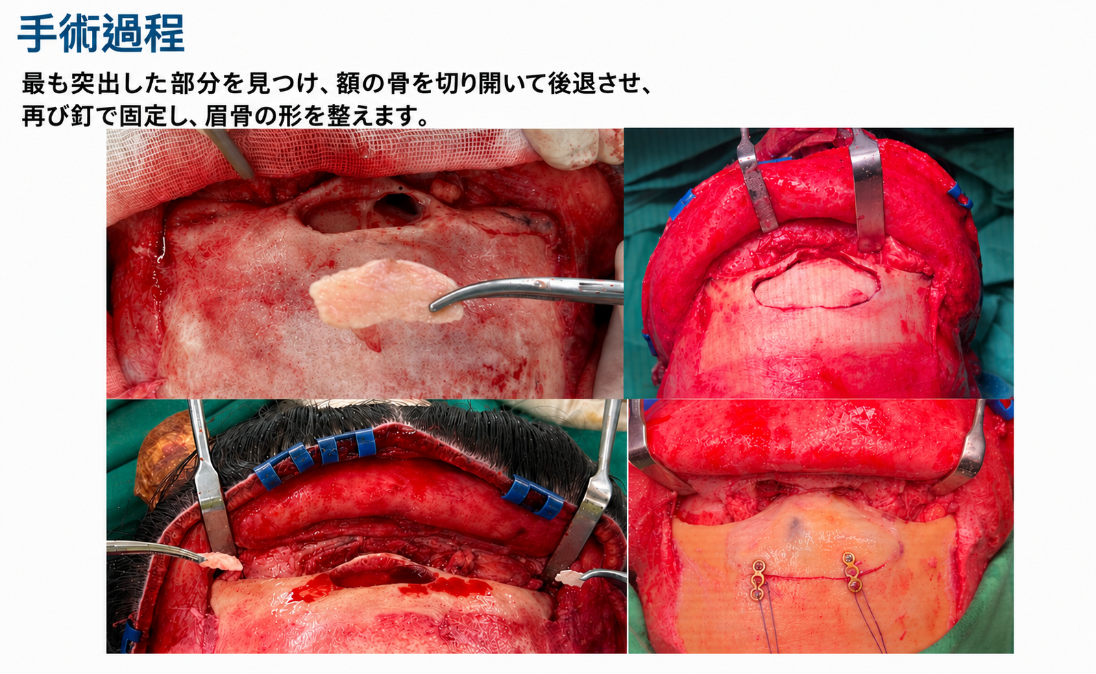 術中の額形成画像。