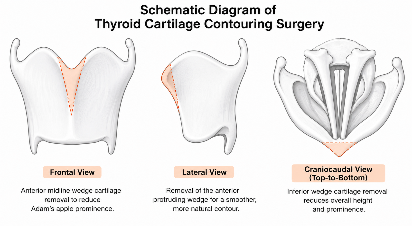 Diagram of thyroid cartilage contouring showing the planned reduction from front, side, and inferior views