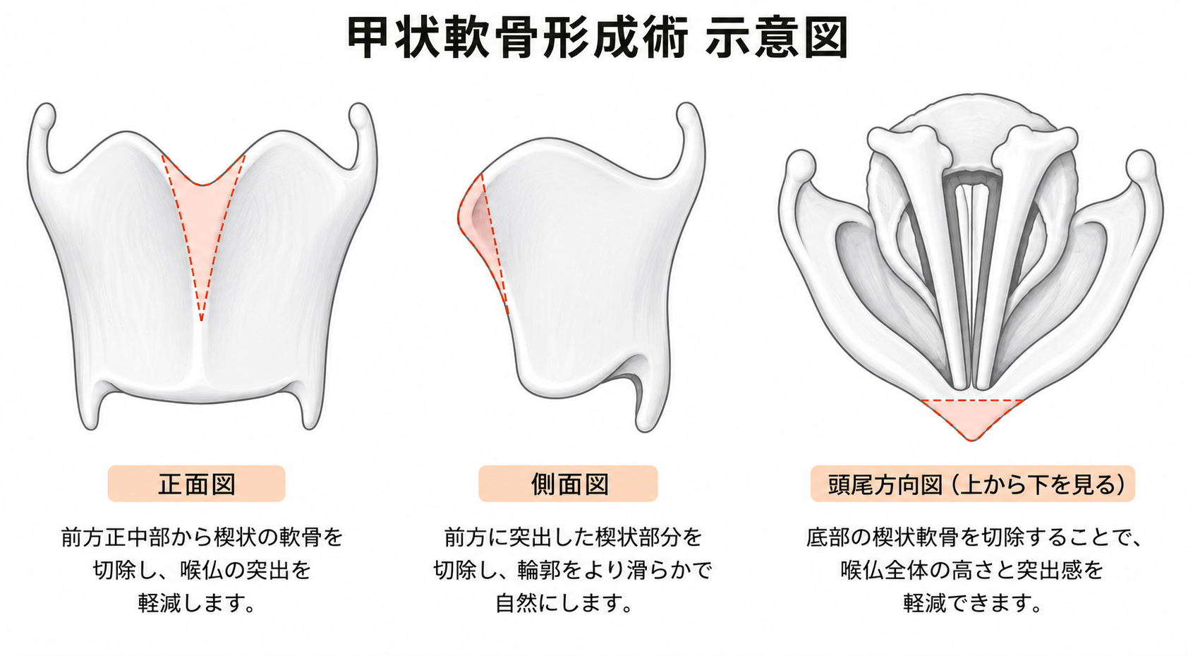 甲状軟骨形成術の模式図。正面・側面・下方視点で切除範囲を示す
