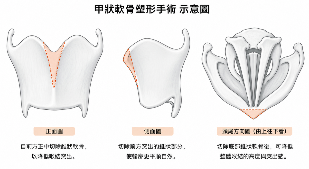 甲狀軟骨塑形手術示意圖，展示正面、側面與頭尾方向的修整範圍